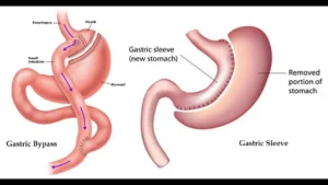 فرق عمل اسلیو با بای پس معده