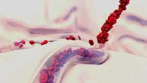 خونریزی بعد از عمل بای پس معده